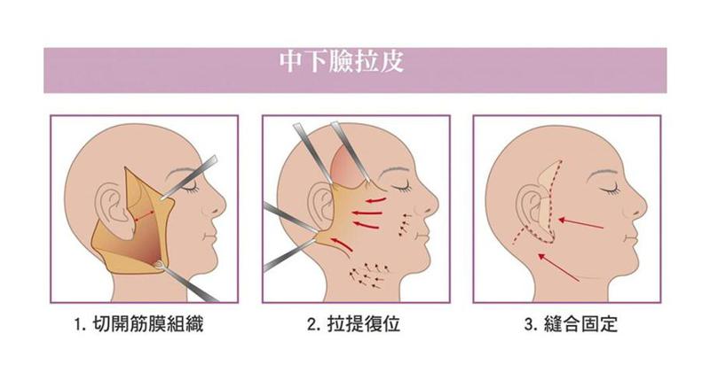 中面部拉皮手术切口位置及护理指南：效果如何？