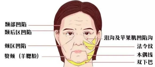 如何选择合适的去皱方法？自体脂肪填充法令纹的费用与效果分析