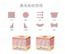 激光祛疤效果及费用解析，哪个方法更优？