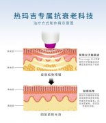 热玛吉与超声提拉：抗衰效果与适用人群的深度解析