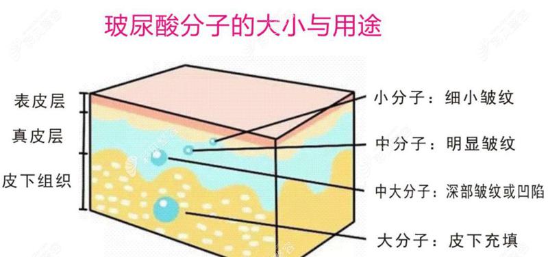 YVOIRE玻尿酸效果如何？价格与效果的权衡