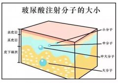 玻尿酸丰太阳穴效果怎么样？维持时间与费用解析