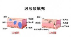 注射瘦脸与玻尿酸：效果、费用与安全性的解析