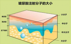 玻尿酸填充太阳穴：费用多少？效果如何？