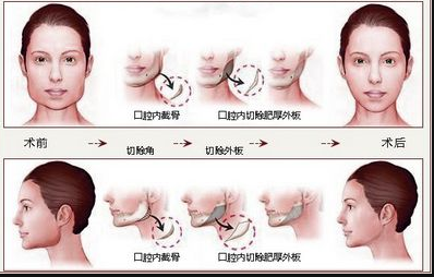 下颌角整形手术：怎么样选择适合自己的方式？