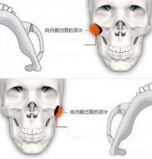 下颌角整形手术效果如何，费用解析