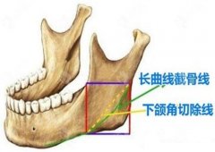 下颌角整形术后护理要点及费用解析