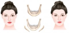 下颌角整形术后疤痕情况及费用解析