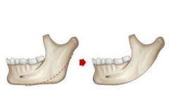 下颌角整形手术效果如何？手术费用解析及医院选择指南