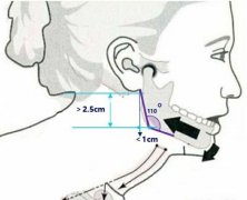 下颌角截骨手术恢复期怎么样？术后恢复及注意事项解析