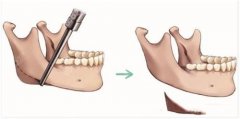 下颌角整形手术：效果如何，费用多少，术后恢复期维持多久？