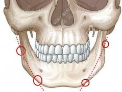 下颌角整形手术怎么样，费用多少？
