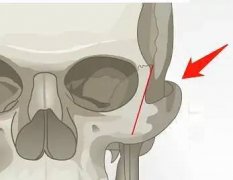 下颌角磨骨术术后恢复指南：怎么样快速恢复，费用多少？