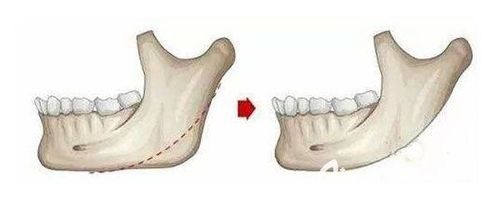 磨骨手术效果与费用详解