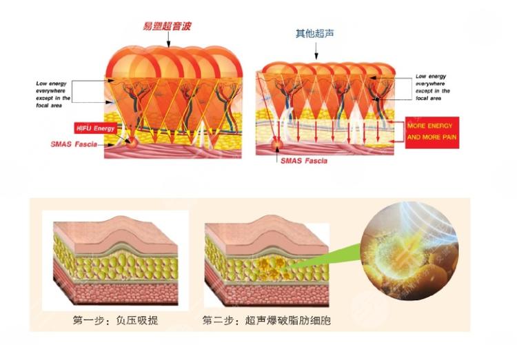 超脂塑效果如何？费用多少？解析医美瘦身新选择