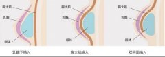 胸部整形费用解析：影响因素与术后护理