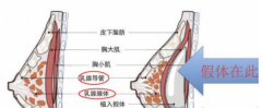 注射丰胸的风险与效果：费用与选择指南