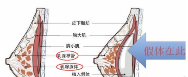 自体脂肪隆胸手术后遗症解析及注意事项