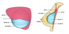 水滴隆胸手术费用解析：晋城地区价格概览