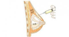 自体脂肪隆胸效果如何？费用多少？手术效果好不好？