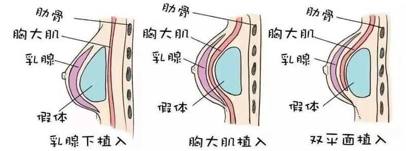 产后隆胸手术效果如何？费用解析