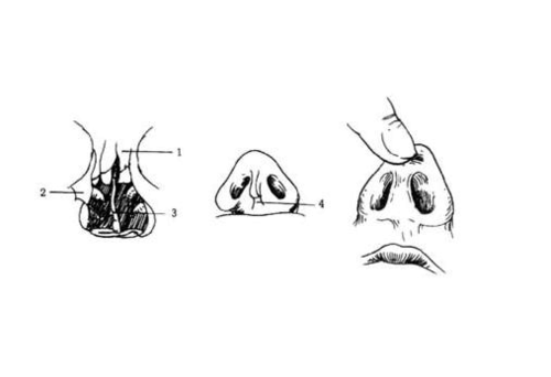 自体隆鼻术后护理要点及效果评估