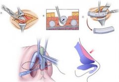 鼻部整形手术：效果好不好，费用多少？