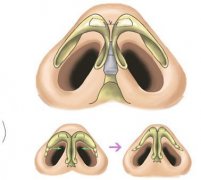 硅胶隆鼻手术的注意事项及其效果维持时间