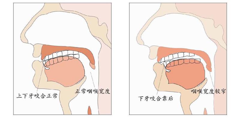 玻尿酸隆鼻效果如何及费用解析