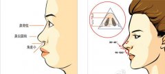 膨体隆鼻手术适合鼻炎患者吗？费用多少？效果如何？