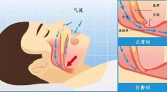 鼻部整形效果如何 鼻部整形费用解析