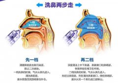 鼻部整形：效果如何，费用多少