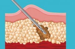 怎么样选择吸脂减肥？吸脂手术原理及效果展示