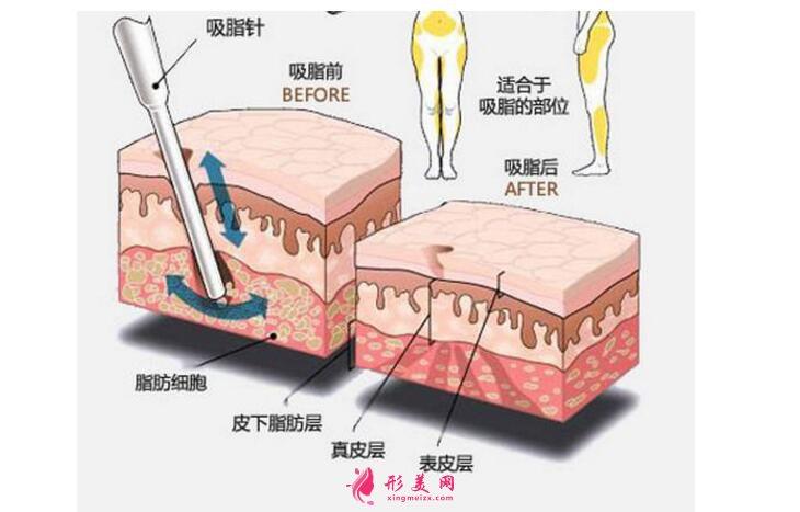 水动力吸脂效果如何？费用多少？与其他吸脂方式有何区别？