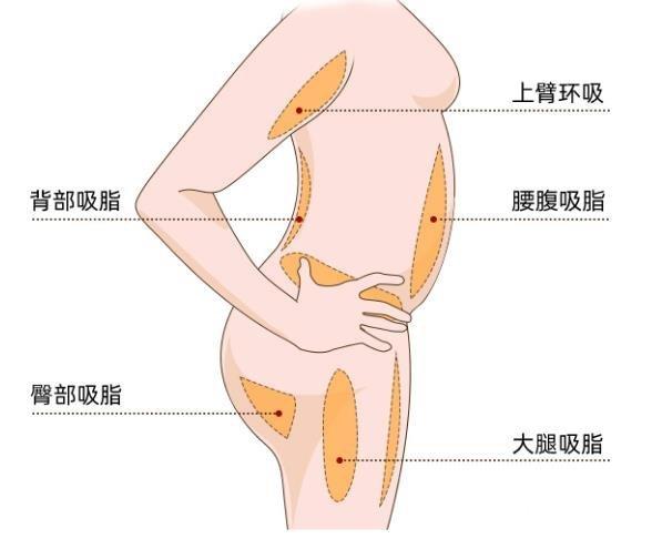 吸脂减肥的注意事项及费用解析