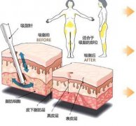 大腿吸脂术后肿胀期及效果维持时间解析