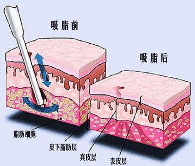 背部吸脂手术效果如何，费用大约多少