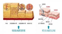 腰腹吸脂减肥怎么样？费用多少？效果如何？