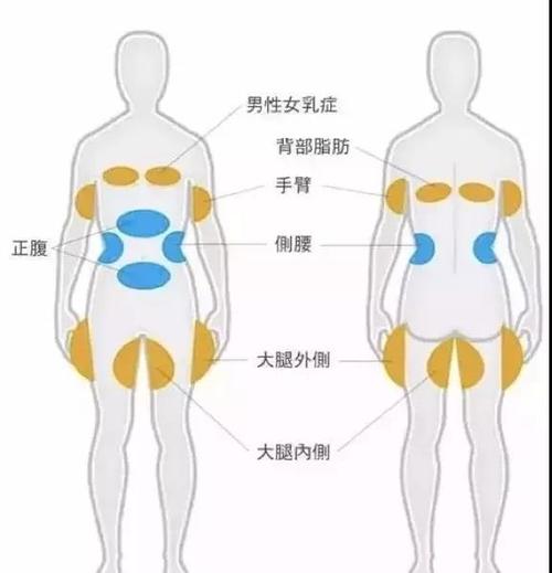 水动力吸脂减肥效果如何？费用多少？