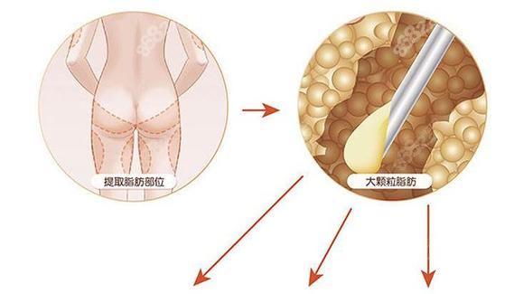 大腿吸脂术后肿胀期及效果维持时间解析