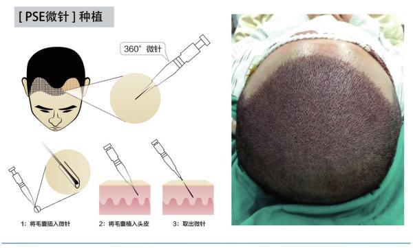 M型发际线植发手术费用解析及技术比较