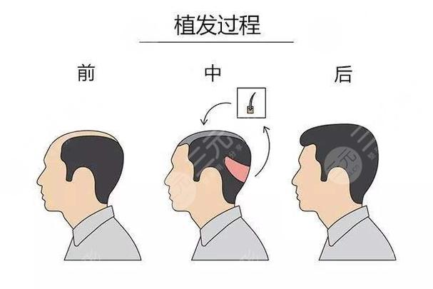 植发手术费用解析：费用多少？效果如何？