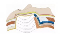 深蓝射频与热拉提：哪个更适合你？效果、费用与维持时间解析