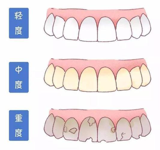 牙齿美白的秘诀：怎么样选择适合自己的方法？