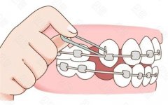 牙齿矫正器怎么样？澳洲t4a使用指南及费用解析