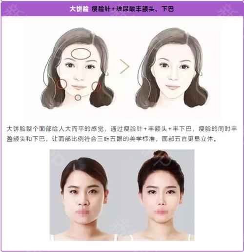 V-Line瓜子脸整形：效果、费用与维持时间解析