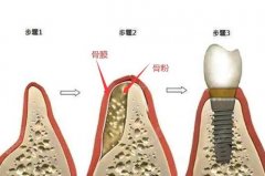 如何选择适合自己的种植体：价格、效果与品牌对比