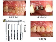 奥齿泰种植牙效果如何？费用多少？解析优缺点及使用时长