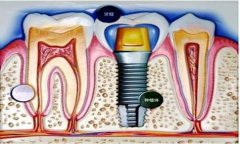 牙齿修复：种植牙与镶牙，哪个更适合你？