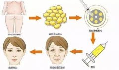 额部脂肪填充效果能保持多久？脂肪吸收现象解析